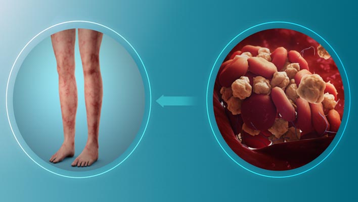 how to prevent blood clots in legs naturally